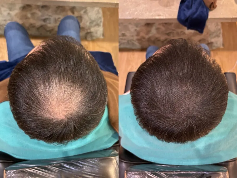 Before and after 1 session, photo 2