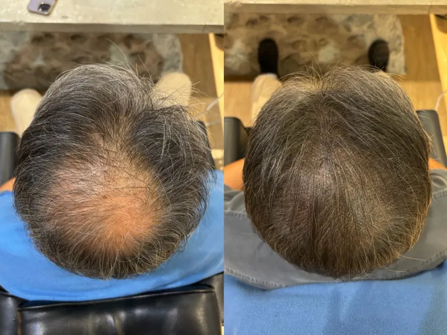 Before and after 1 session, photo 3