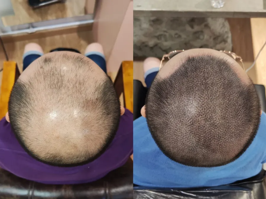 Before and after 1 session, photo 4