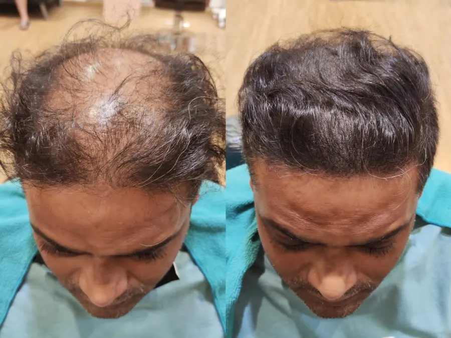 Before and after 1 session, photo 1