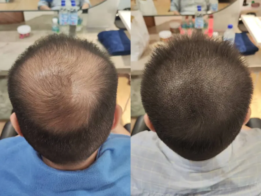 Before and after 1 session, photo 10